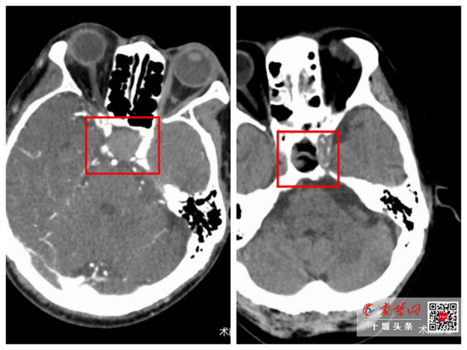 經(jīng)鼻潛入腦，切瘤不傷腦 十堰人醫(yī)成功實施經(jīng)鼻蝶垂體瘤微創(chuàng)切除術(shù)