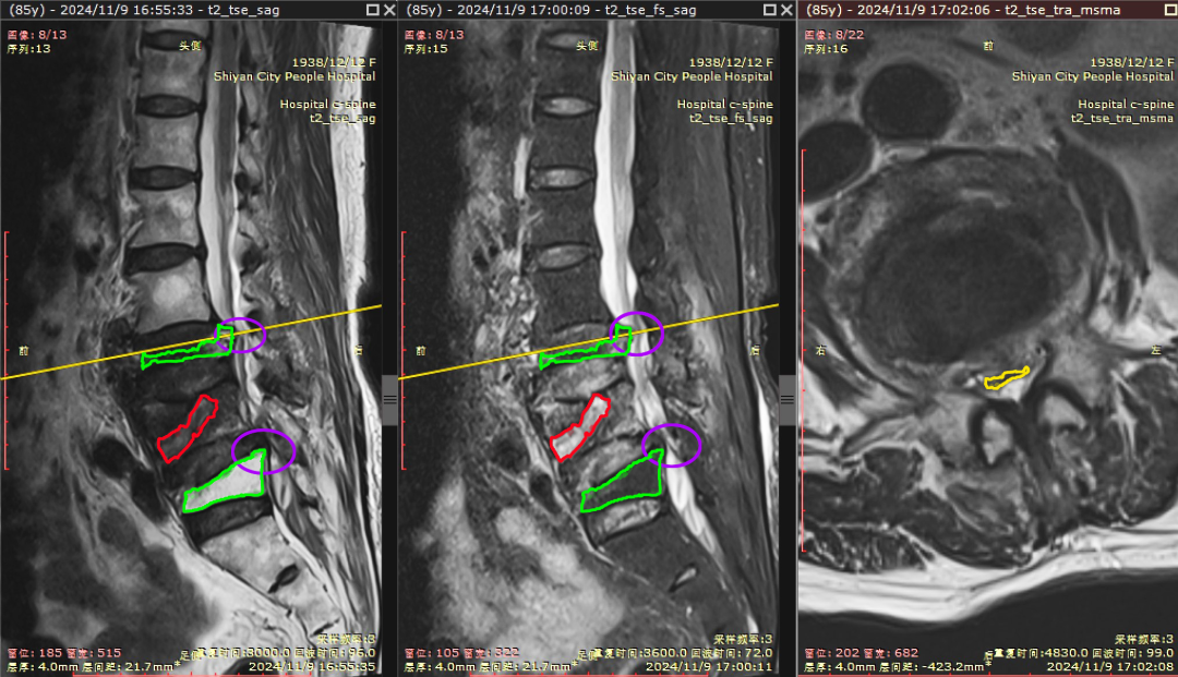 端水閃著腰，一查竟腰椎骨折！十堰人醫(yī)：這類人群要警惕