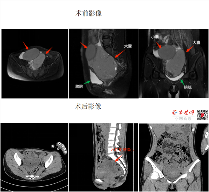 不開刀！十堰人醫(yī)一根“針”解決女性常見巧克力囊腫難題