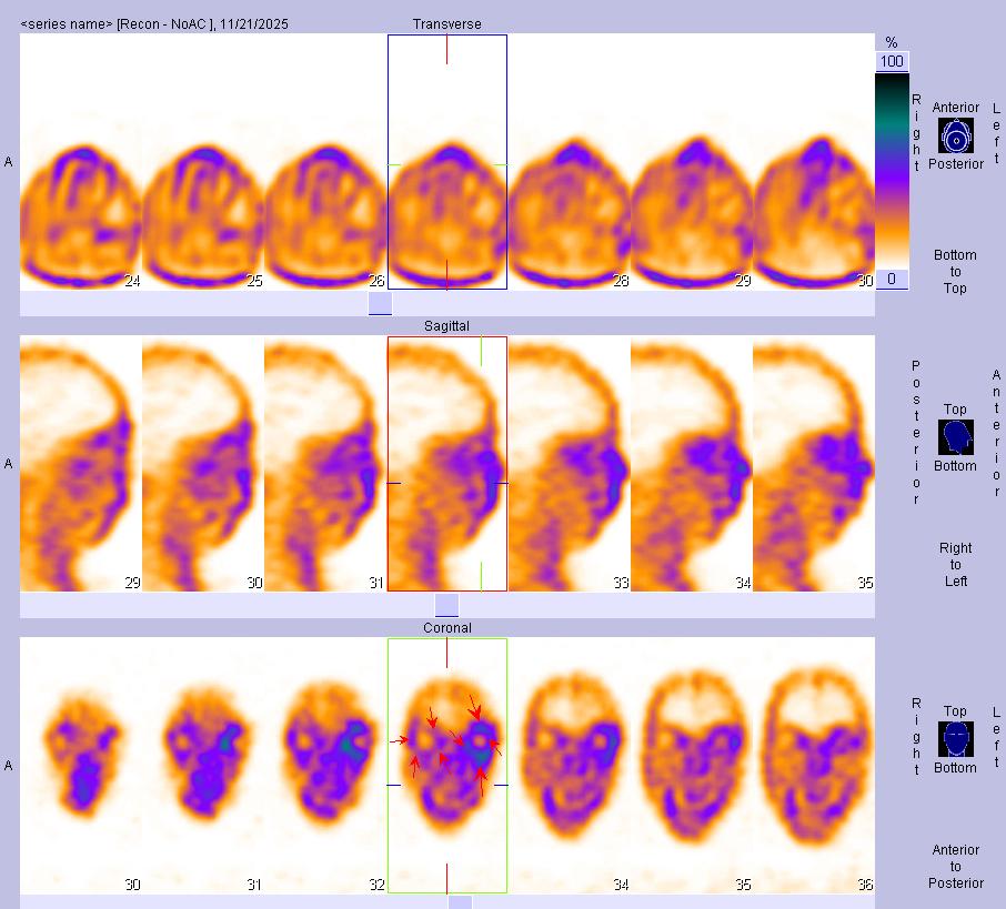 十堰人醫(yī)核醫(yī)學(xué)科：甲狀腺相關(guān)性眼病顯像檢查流程及注意事項(xiàng)