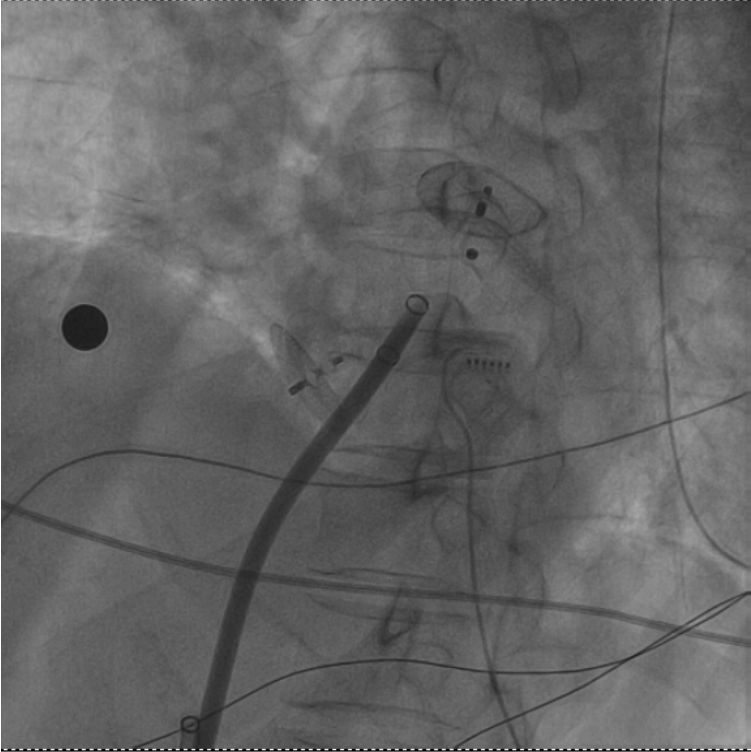 一次穿刺行兩個(gè)手術(shù)！十堰人醫(yī)成功消除圓孔封堵術(shù)后的房顫與血栓