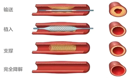 十堰首例！“無痕”支架植入術(shù)成功實施 冠心病治療邁入“可吸收時代” 讓血管重獲自由
