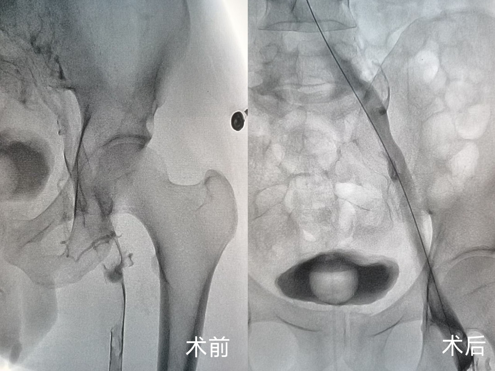 十堰人醫(yī)心胸大血管外科外周靜脈取栓支架系統(tǒng)精準取栓解沉疴